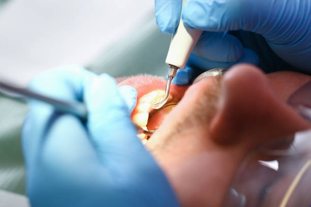 Best Emergency Tooth Extraction in Stevensville, MT